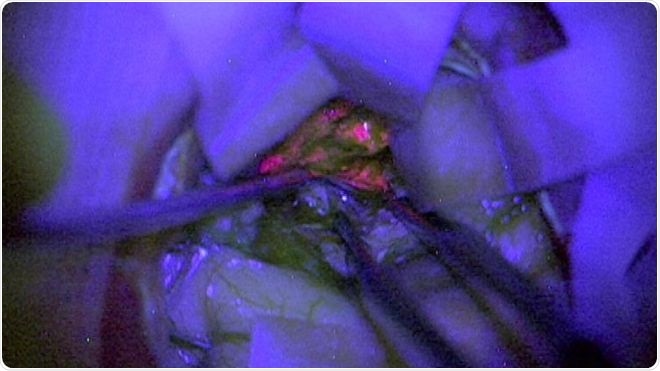   "Improvement of Intraoperative Diagnosis of High-Grade Glioma with the Assistance of 39, a fluorescence biomarker - a result of the NCRI GALA of the United Kingdom »BIDD study, Kathreena Kurian et al. M 