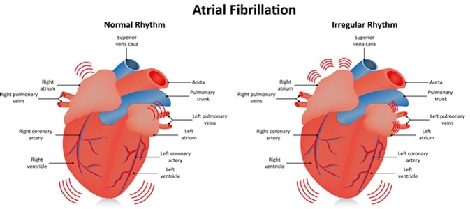   Atrial fibrillation - Photo credit: Joshya / Shutterstock 