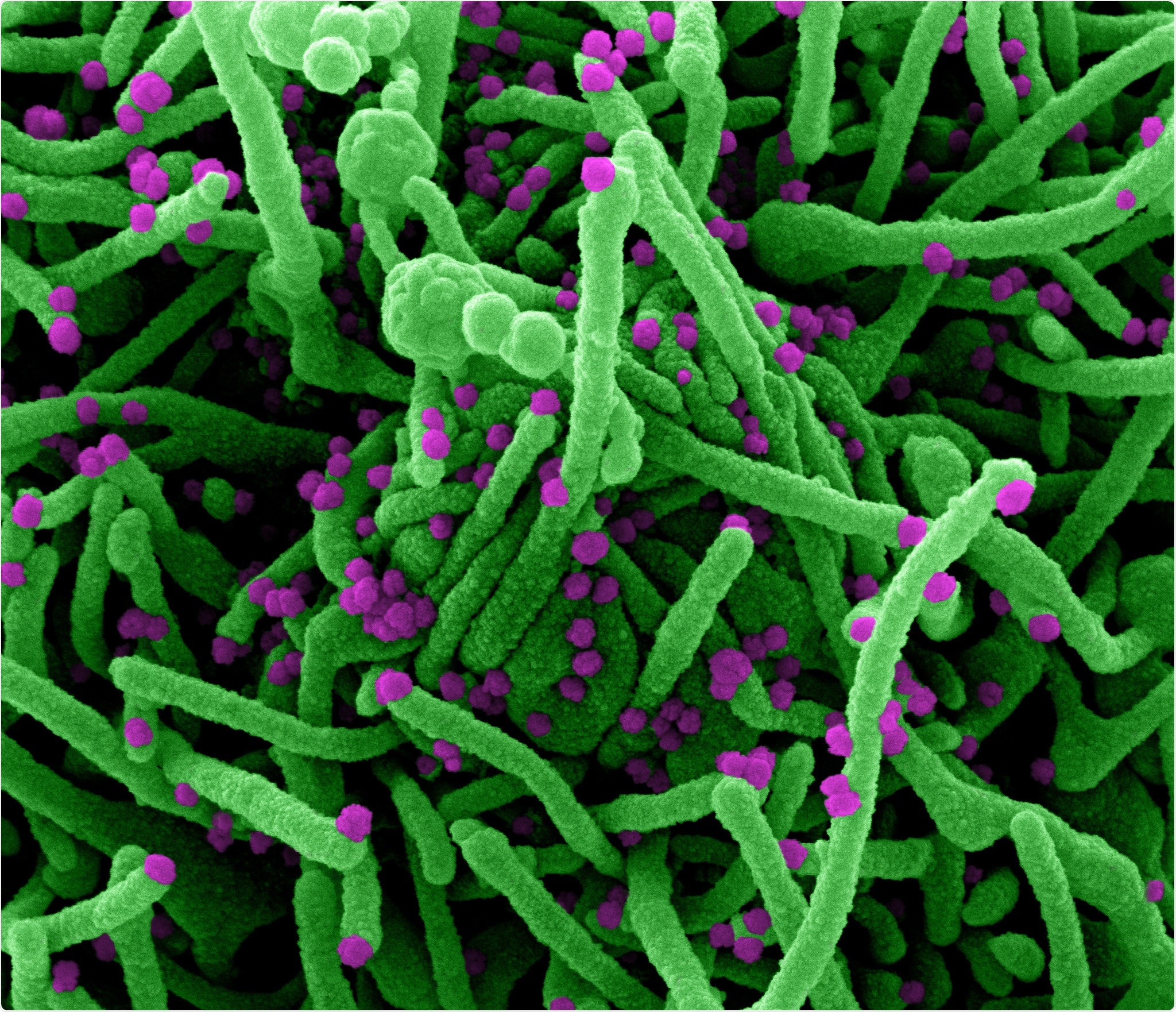 Novel Coronavirus SARS-CoV-2 Colorized scanning electron micrograph of a cell (green) infected with SARS-COV-2 virus particles (purple), isolated from a patient sample. Image captured at the NIAID Integrated Research Facility (IRF) in Fort Detrick, Maryland. Credit: NIAID