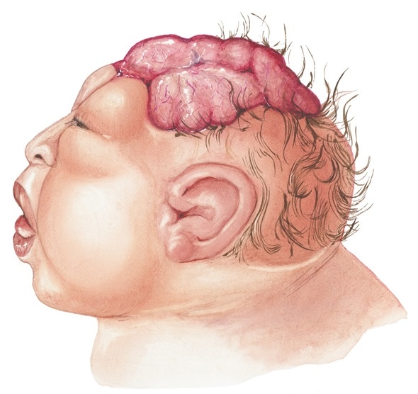 Anencephalie Developpement Anormal De Cerveau Et De Crane