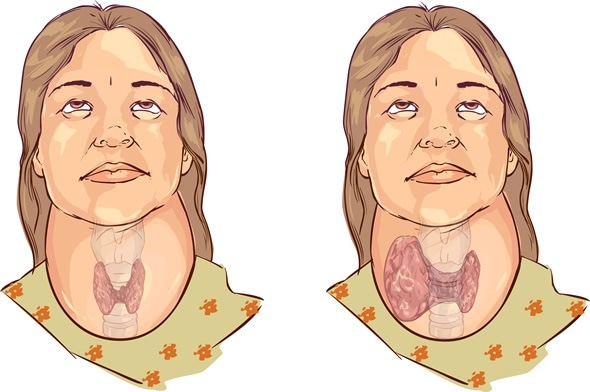 Goiter Causes