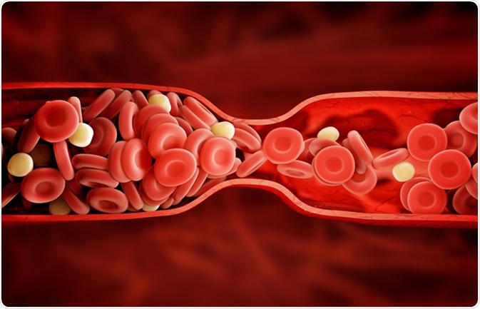 What Is Fibrinolysis