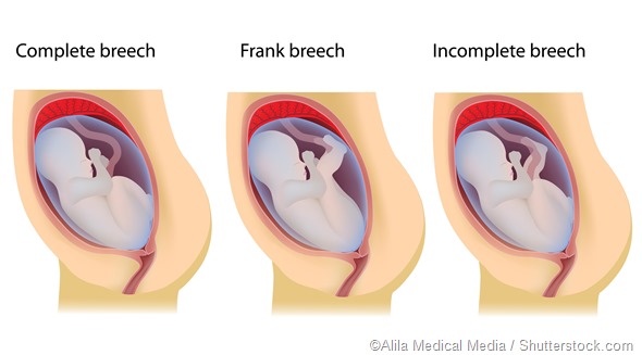 Naissance Enculassee Cesarienne Ou Distribution Vaginale