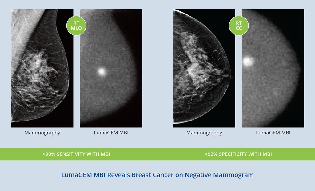 Dense breasts on a mammogram? What to know and do - Harvard Health