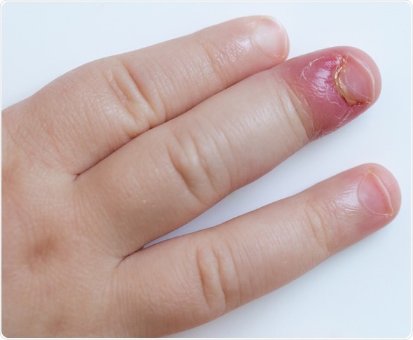 What To Do If You Have An Infected Cuticle