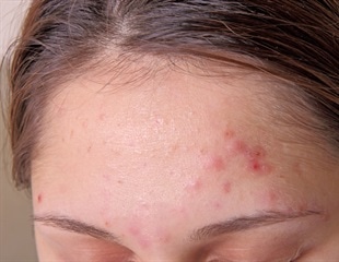 Acne Research