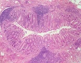 Acute Appendicitis Overview