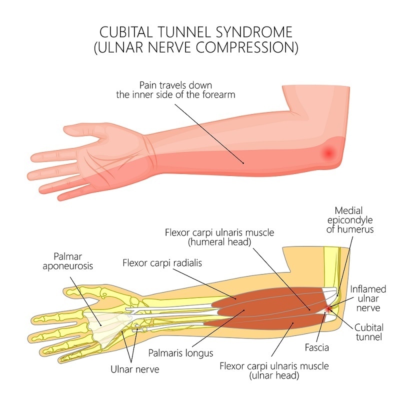nerve compression syndrome