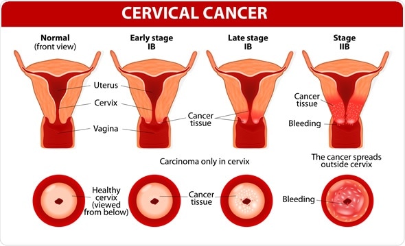 and Cervical