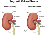 What Are Kidney Cysts