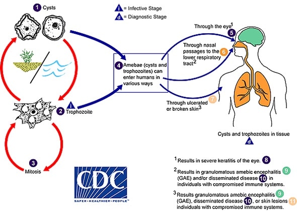 Types of Acanthamoeba Infection