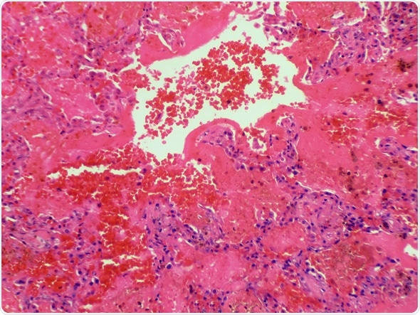 Goodpasture Syndrome