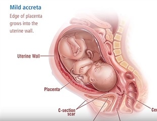 Placenta Accreta