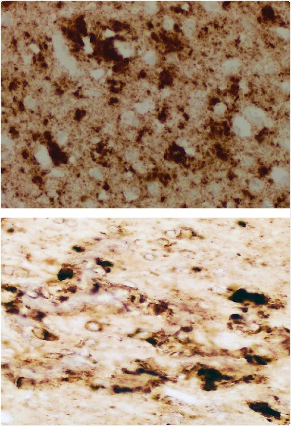 scientists-detect-pathological-prion-protein-in-skin-of-cjd-patients