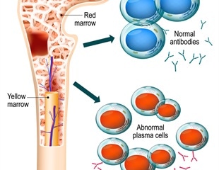 Two immunotherapy approaches for multiple myeloma show hope