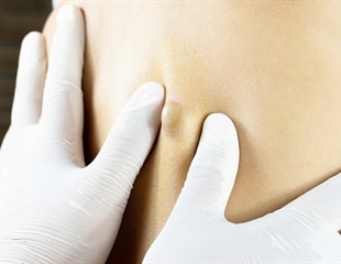 Skin Cysts Sebaceous Cyst