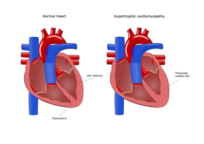 Genetic Mutation Associated with Hypertrophic Cardiomyopathy