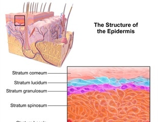 What is Inflammatory Linear Epidermal Nevus?