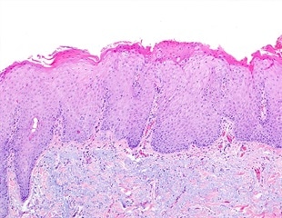 Solar Elastosis / Actinic Elastosis