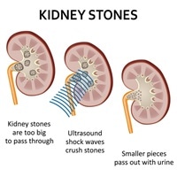 Kidney Stones Treatment
