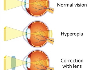 Hyperopia (Far-Sightedness)