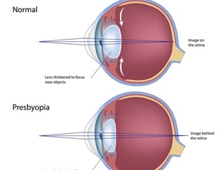 Presbyopia - Age-Related Farsightedness