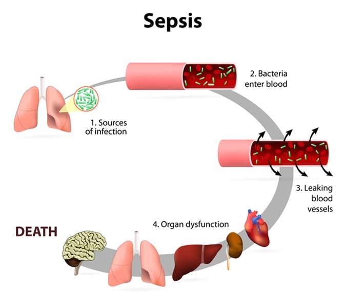 Sepsis Septicemia Treatment