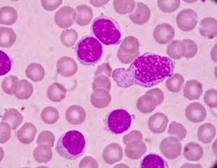 Chronic Lymphocytic Leukemia (CLL) Prognosis