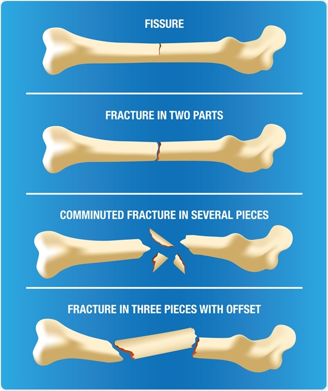 different types of bone fracture