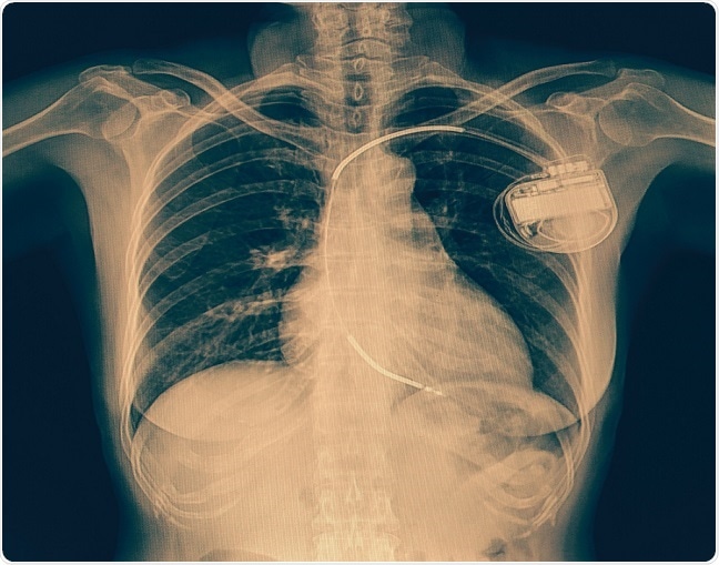 Are Wearable Defibrillators A Suitable Alternative To Surgically