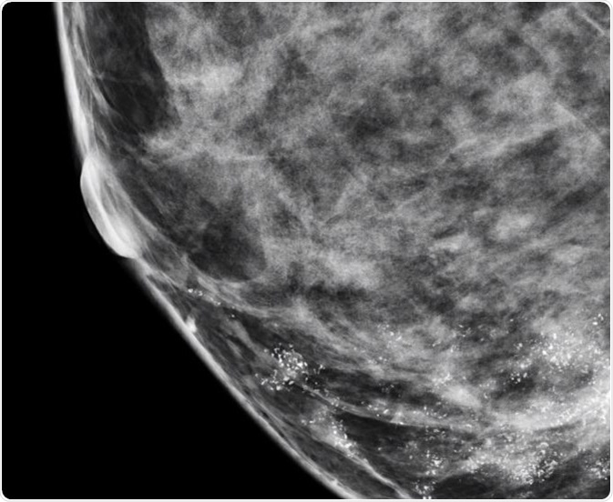 Microcalcifications in Breast Cancer