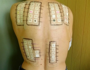 Allergy Patch Testing