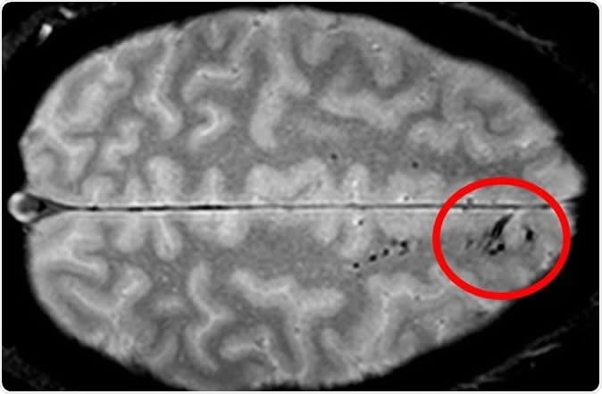 Study shows microbleeds after head injury signal danger to brain function