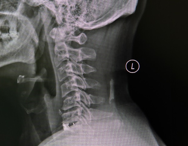 What is Cervical Spondylosis?