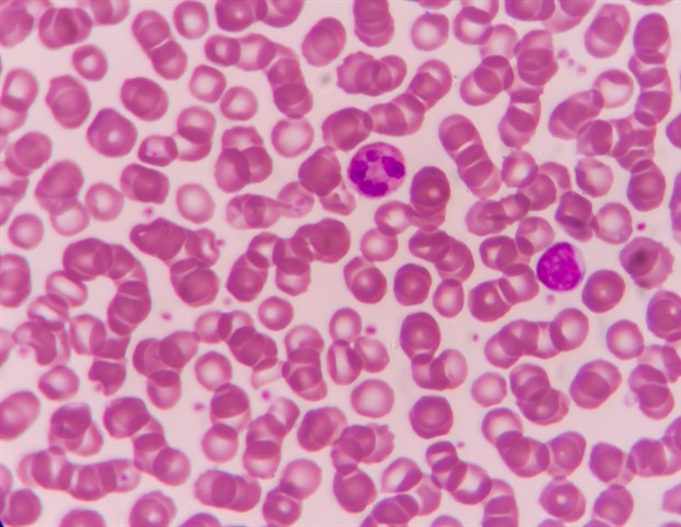 Reducing Anemia in Developing Regions with POC Analysis