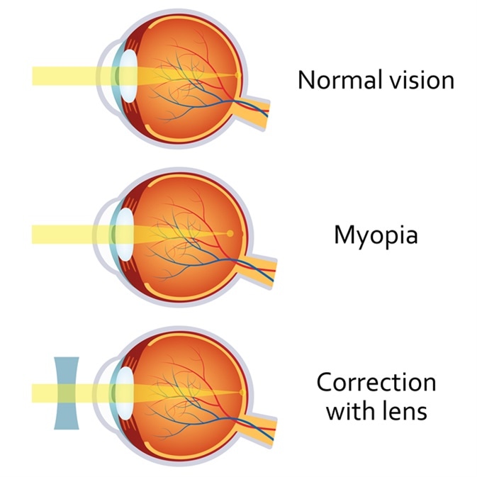 What is Ametropia?