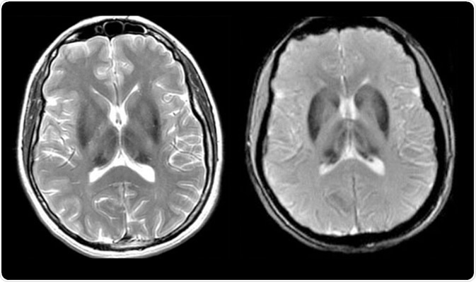 What is Aceruloplasminemia?