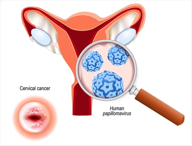 Cervical Cancer Screening And Hpv Vaccination