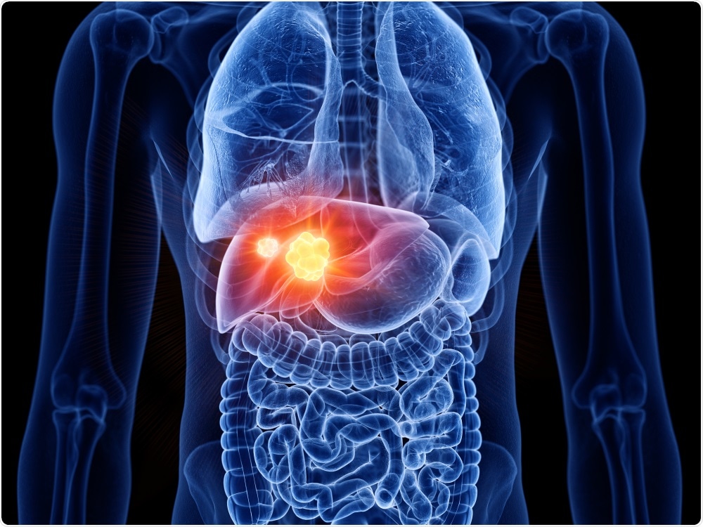 immune-system-contribution-to-tumor-heterogeneity-may-influence-liver