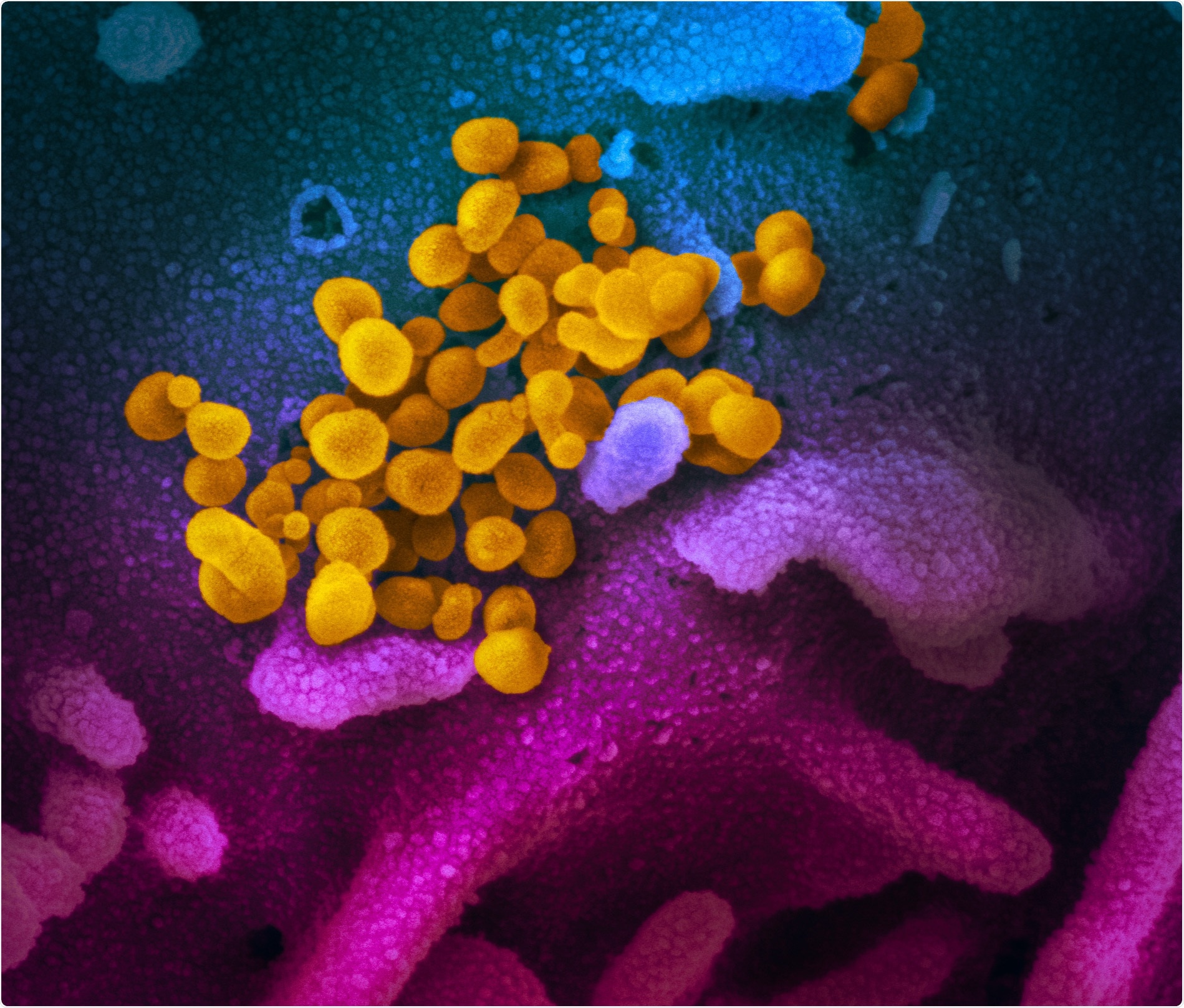 scanning electron microscope image shows SARS-CoV-2 (yellow)—also known as 2019-nCoV, the virus that causes COVID-19—isolated from a patient in the U.S., emerging from the surface of cells (blue/pink) cultured in the lab. Image captured and colorized at NIAID