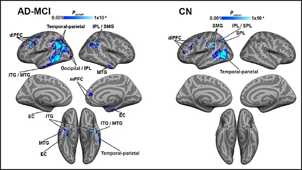 Impaired blood flow to brain regions linked with tau buildup in Alzheimer’s disease