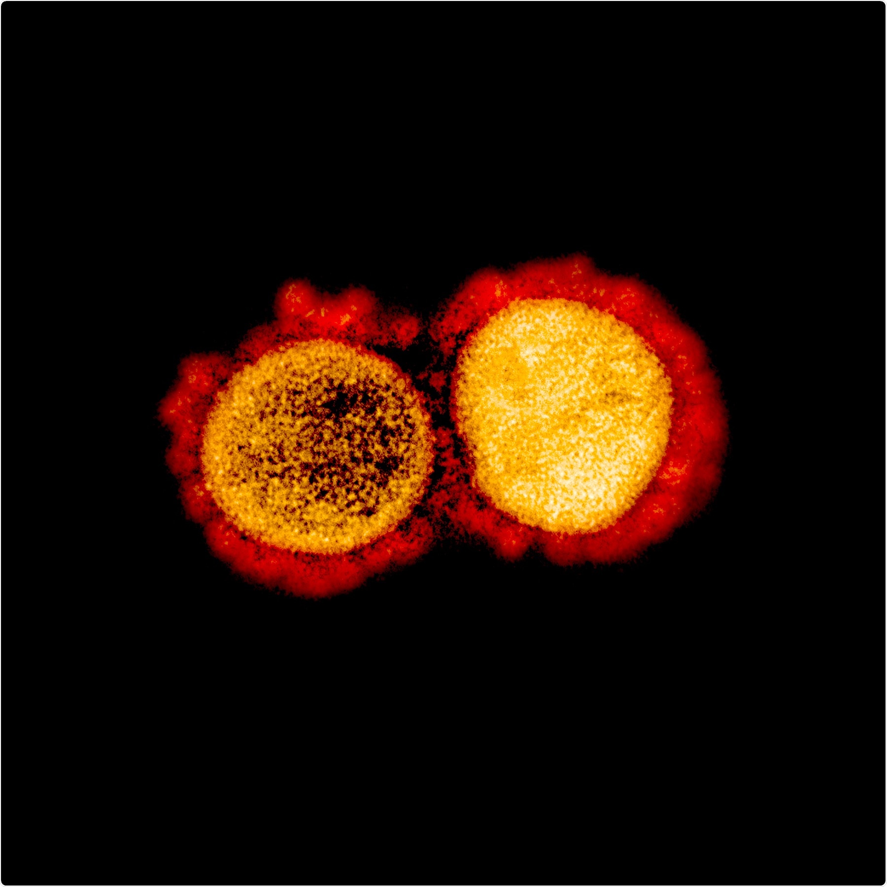 Transmission electron micrograph of SARS-CoV-2 virus particles, isolated from a patient. Image captured and color-enhanced at the NIAID Integrated Research Facility (IRF) in Fort Detrick, Maryland. Credit: NIAID