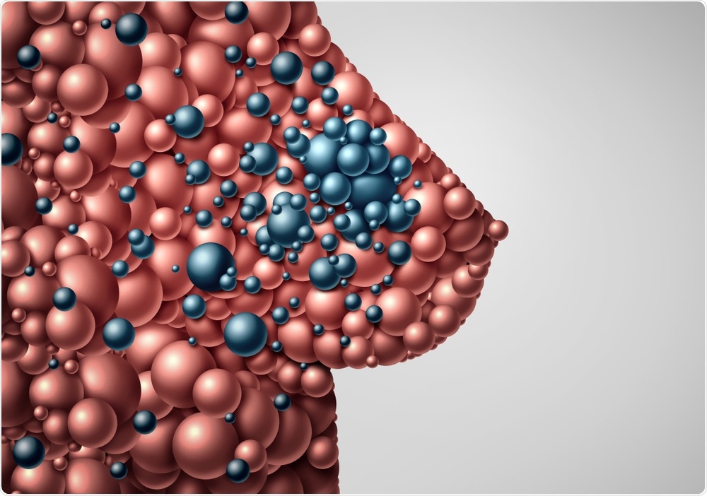 Breast Cancer Metastasis