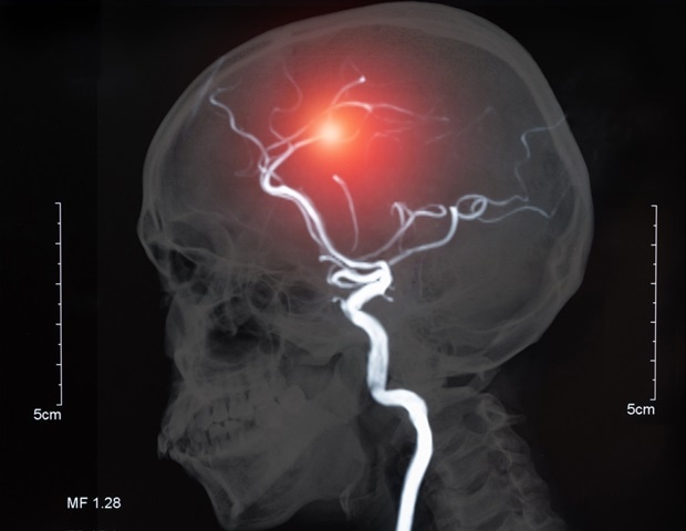 what-is-cerebrovascular-disease