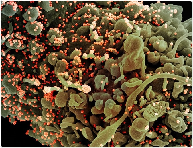 Colored scanning electron micrographs of cells isolated from a novel coronavirus SARS-CoV-2-patient sample showing morphological signs of apoptosis infected with SARS-COV-2 viral particles (orange). Images taken at the NIAID Integrated Research Facility (IRF) in Fort Detrick, MD. Credit: NIAID