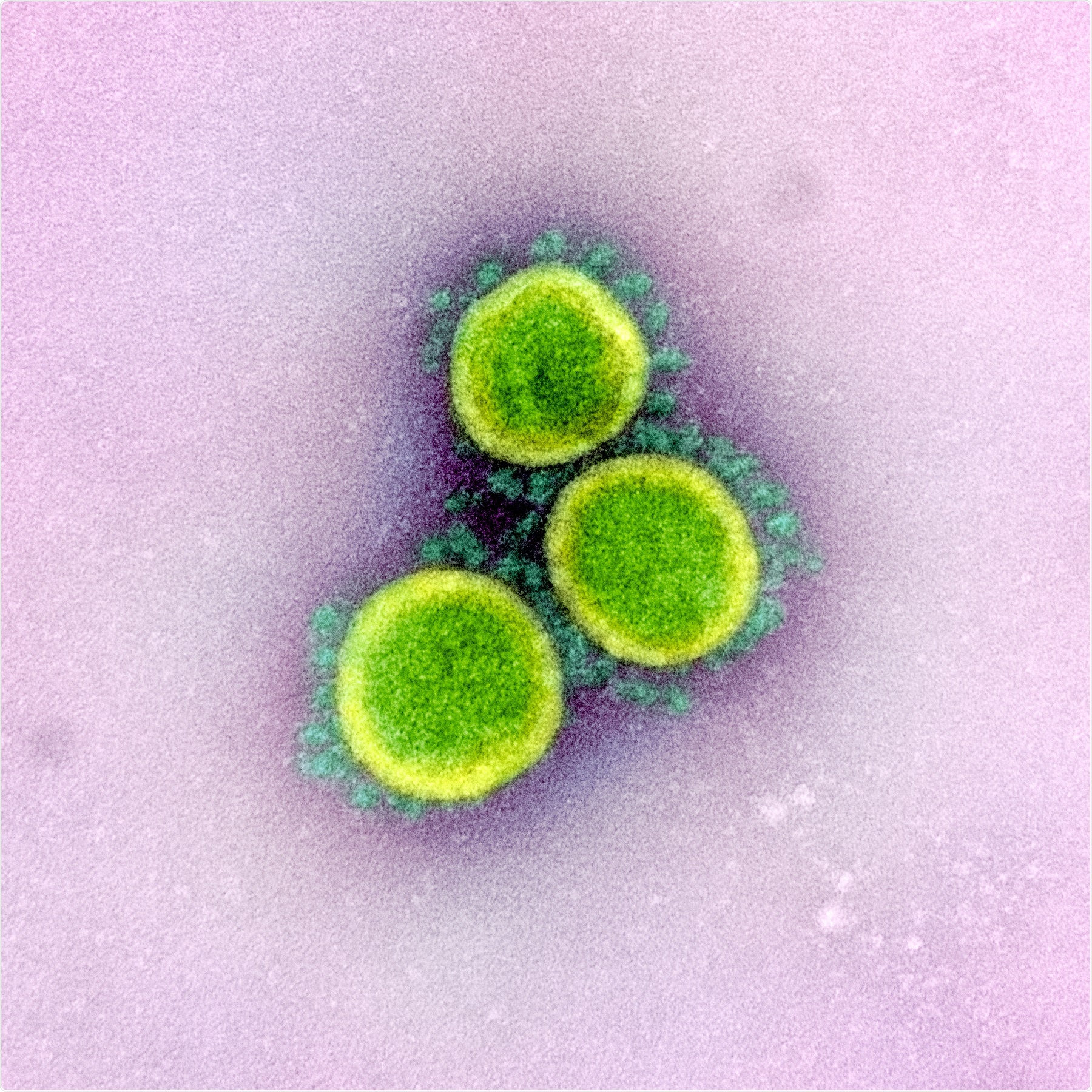 Novel Coronavirus SARS-CoV-2 Transmission electron micrograph of SARS-CoV-2 virus particles, isolated from a patient. Image captured and color-enhanced at the NIAID Integrated Research Facility (IRF) in Fort Detrick, Maryland. Credit: NIAID