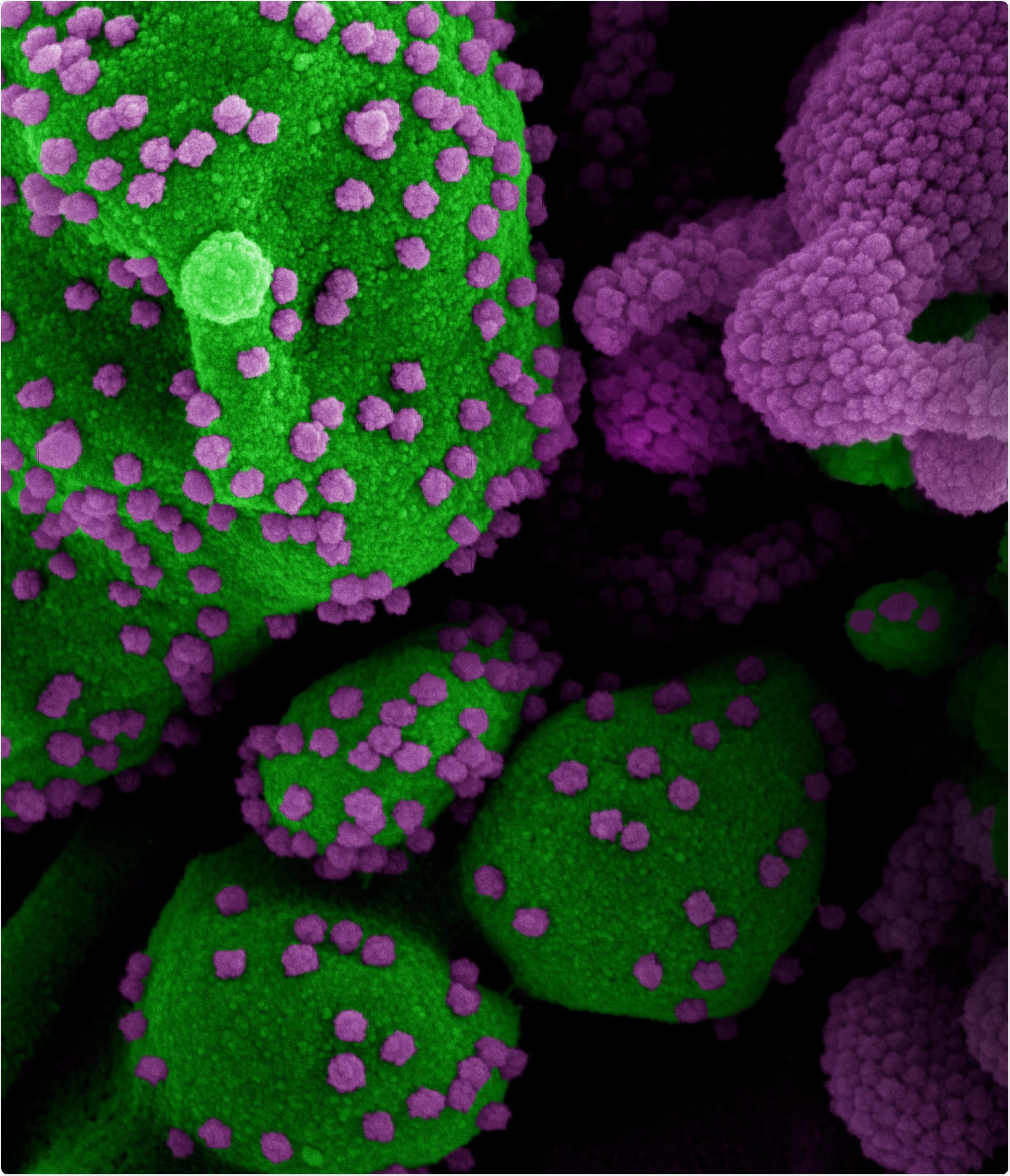 Novel Coronavirus SARS-CoV-2 Colorized scanning electron micrograph of an apoptotic cell (green) heavily infected with SARS-COV-2 virus particles (purple), isolated from a patient sample. Image at the NIAID Integrated Research Facility (IRF) in Fort Detrick, Maryland. Credit: NIAID