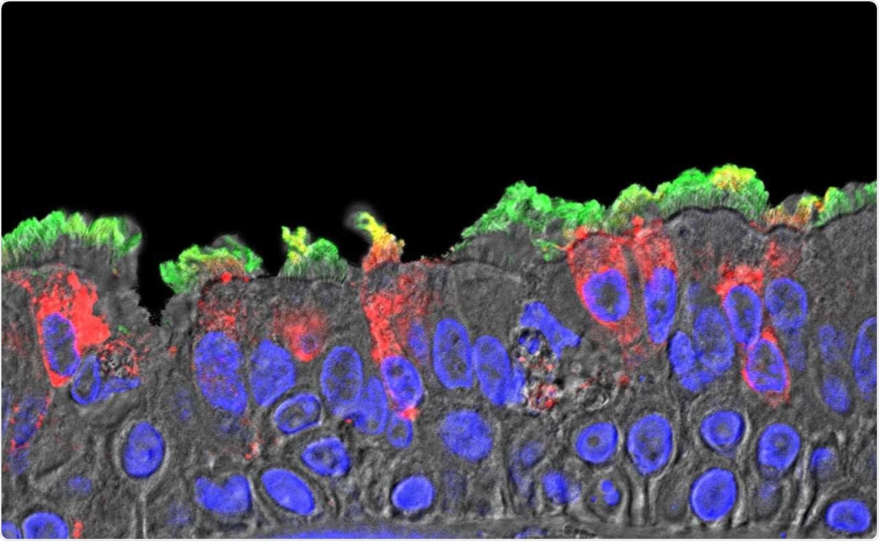 SARS-CoV-2 (red) infected ciliated cells in the COVID-19 patient