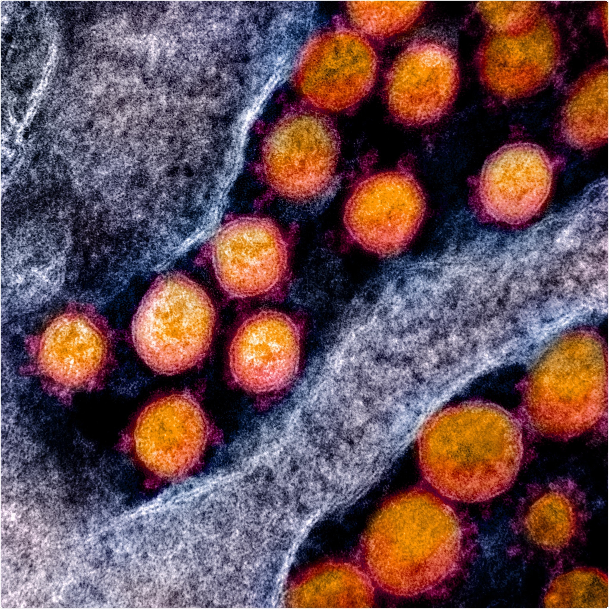 Novel Coronavirus SARS-CoV-2 Transmission electron micrograph of SARS-CoV-2 virus particles, isolated from a patient. Image captured and color-enhanced at the NIAID Integrated Research Facility (IRF) in Fort Detrick, Maryland. Credit: NIAID