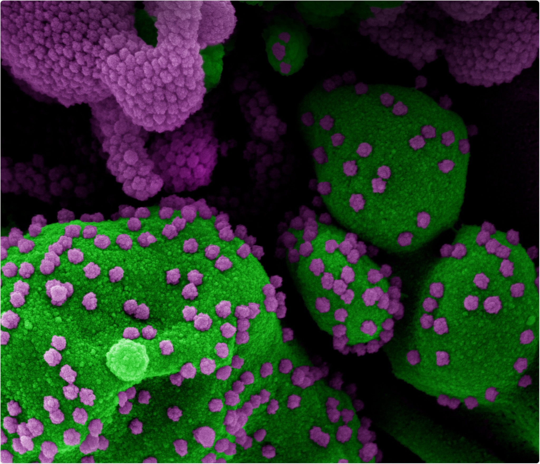 Novel Coronavirus SARS-CoV-2 Colorized scanning electron micrograph of an apoptotic cell (green) heavily infected with SARS-CoV-2 virus particles (purple), isolated from a patient sample. Image at the NIAID Integrated Research Facility (IRF) in Fort Detrick, Maryland. Credit: NIAID